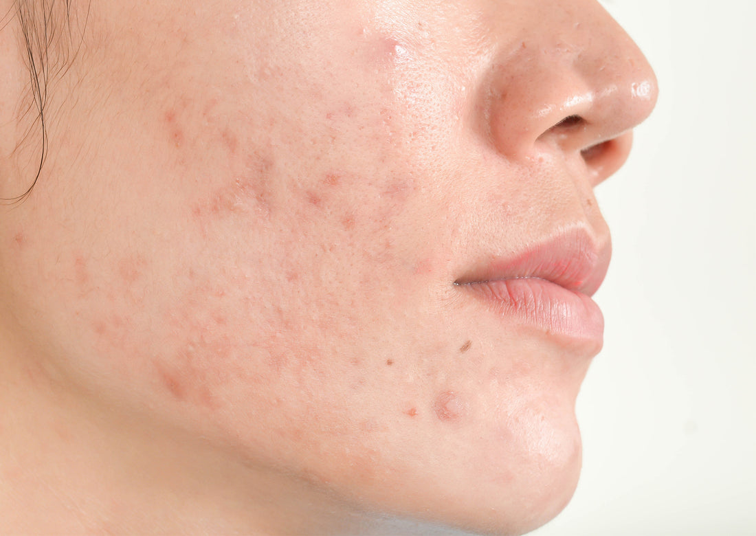 Effective Chinese Herbal Herb Remedy Remedies Acne