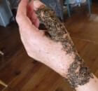 Boneset "Casts" for Healing Bones